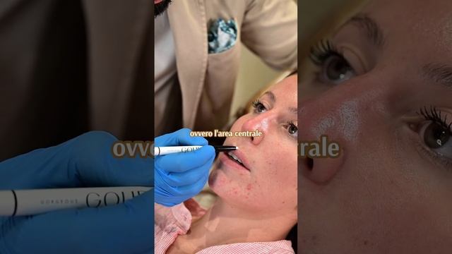 Filler labbra: il trattamento смотреть онлайн