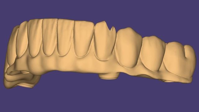 Мост Циркониевая ZrO2 коронка смотреть онлайн