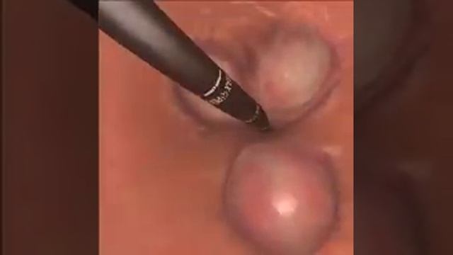 Flexible Endoscopy Through The Sigmoid Colon On GI Mentor By Simbionix