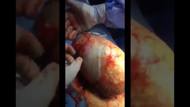 Baby born inside the amniotic sac (The miracle of life).. смотреть онлайн