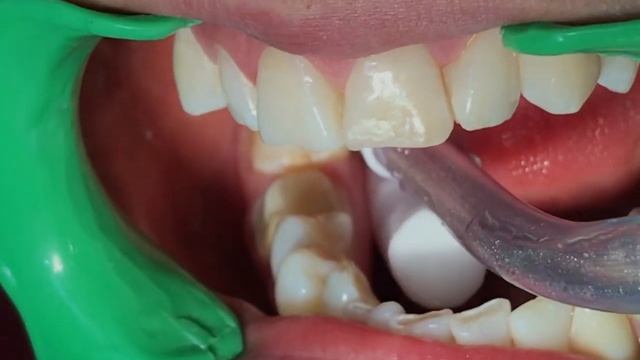 Corona LIBRE DE METAL (E-MAX) POST-ENDODONCIA [caries Bajo Amalgama] #2