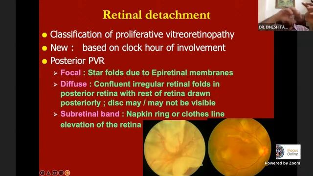 iFocus Online#203, Retina#55, Dr Dinesh Talwar, Rhegmatogenous Retinal Detachment - Basics смотреть онлайн