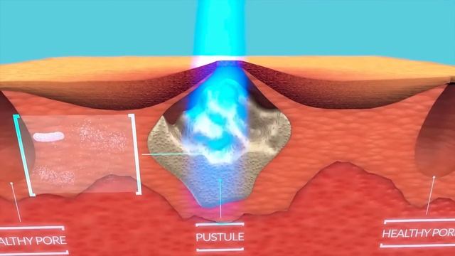 How Blue Light Therapy Works To Treat Acne смотреть онлайн