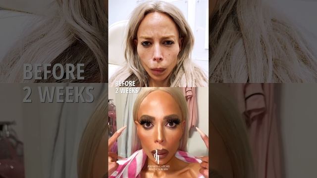 Before + After Botox Results | Dr. Johnson C. Lee | Beverly Hills, CA смотреть онлайн