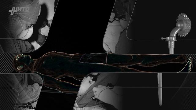 Визуализации | эндопротезы Сиваша | 2024 смотреть онлайн