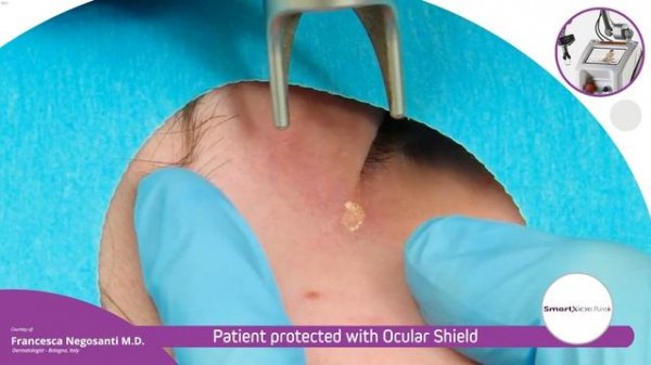 Лазер Дека DEKA SmartXide   Вапоризация ксантелазм на СО2 лазере Дека