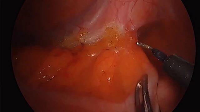Laparoscopic sigmoid resection #6 смотреть онлайн