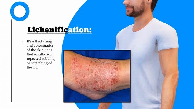 Chapter. 1: Primary and Secondary lesions of the skin. Fitzpatrick Dermatology Part. 1 смотреть онлайн