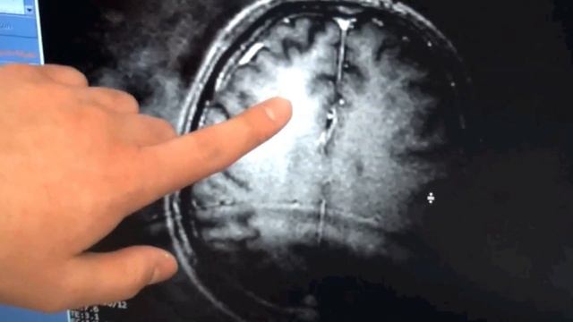 First Alzheimer's Patient Treated With Focused Ultrasound To Open The Blood-brain Barrier