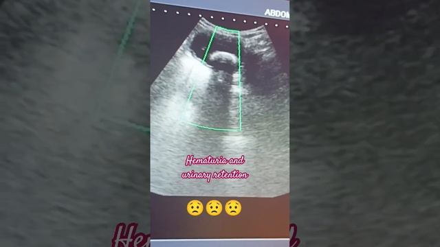 #Hematuria And Urinary Retention In Five Years Old Baby