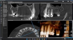 Обработка КЛКТ в OnDemand3D