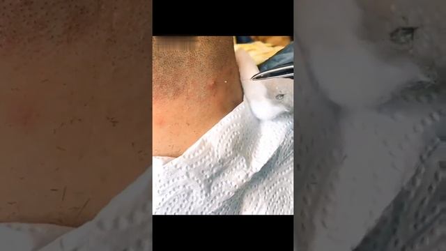 ازالة شعر من تحت الجلد 265 смотреть онлайн
