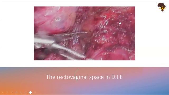 Is your Endometriosis Anatomy up to date? | Dr. Yamal Patel смотреть онлайн