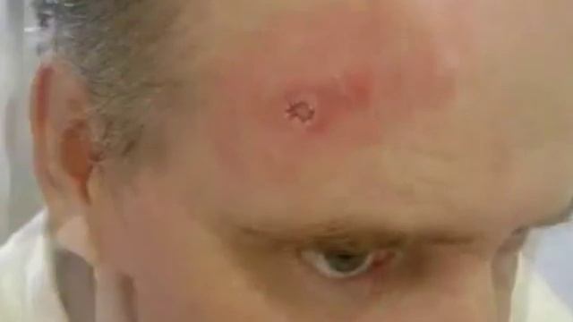 Curaderm Cream Video Testimonial