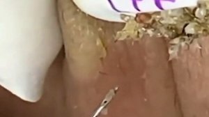 Прыщи  Огромные прыщи  Релакс с акне  Выдавливание прыщей  Черная точка  #Прыщи