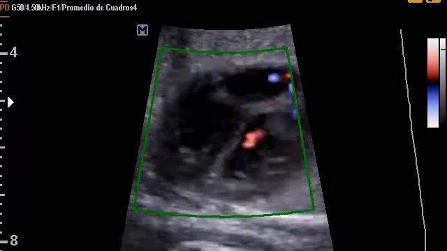 A 30 SAMSUNG MEDISON Corazòn Fetal con PDDI смотреть онлайн
