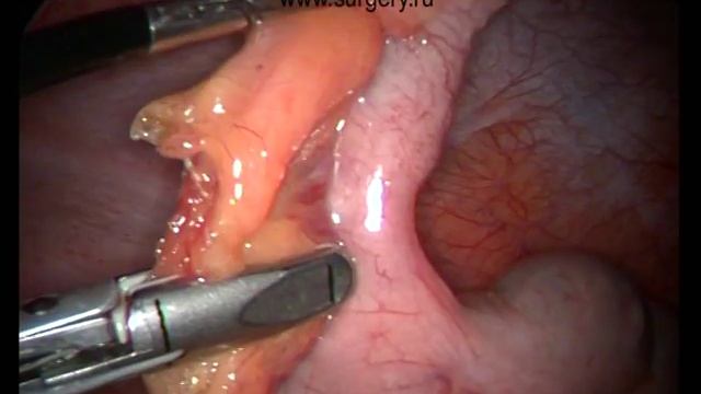 Laparoscopic appendectomy for acute appendicitis смотреть онлайн