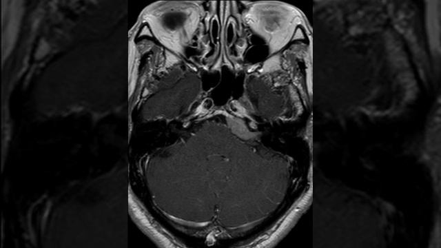 CNS C10 CP angle meningioma смотреть онлайн