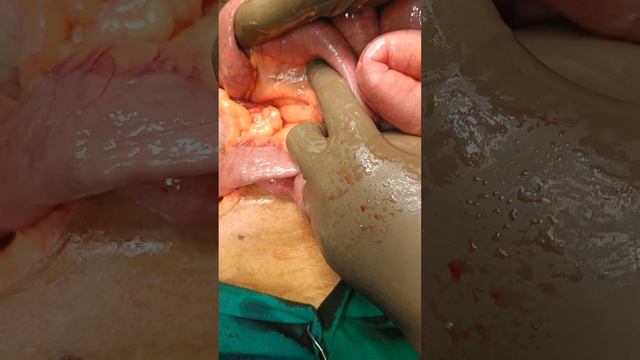 ileo colic intususception #abdominal #open #complex смотреть онлайн