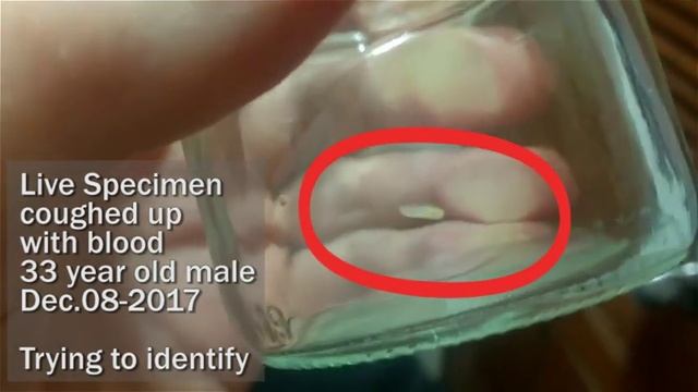 Parasite/Worm Coughed Up with Blood Dec08 2017 смотреть онлайн