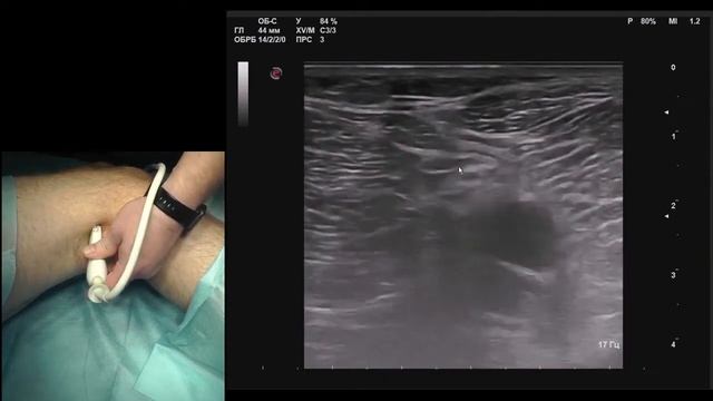 Popliteal Sciatic Block Ultrasound | Ягодичный нерв блокада УЗИ смотреть онлайн