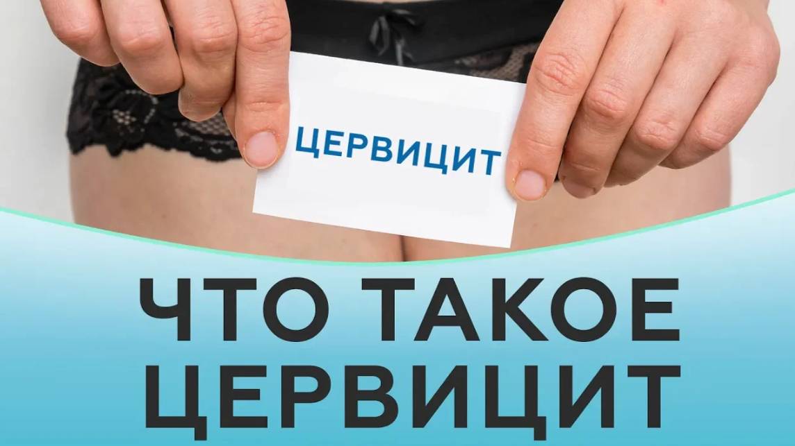 Что такое цервицит. Эндоцервицит и экзоцервицит смотреть онлайн