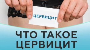 Что такое цервицит. Эндоцервицит и экзоцервицит