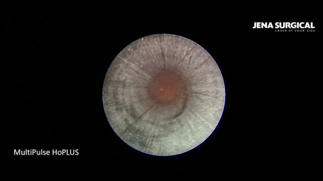 Гольмиевый лазер Камень почки 1,5см. Литотрипсия на аппарате MultiPulse HoPLUS. смотреть онлайн