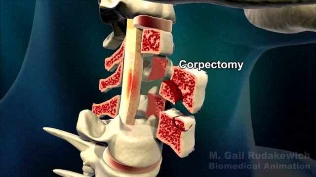 Riluzole As Treatment For Spinal Cord Injury