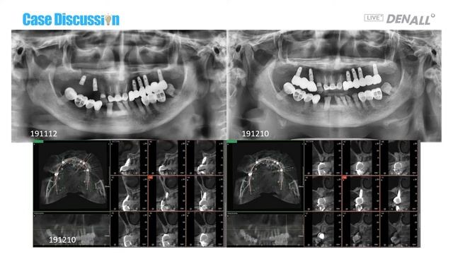 [CASE DISCUSSION] #13~15, Sinus lift? GBR? смотреть онлайн