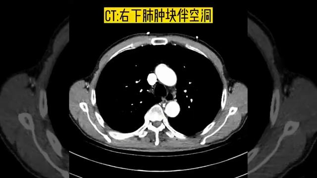 肺鳞癌 смотреть онлайн