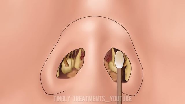 ASMR Nose Mucus Deep Cleaning Animation | Massive Booger And Unmanaged Piercing Removal