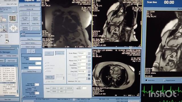 MRI Cardiac For Chambers Viability In GE HDXT 1.5 T