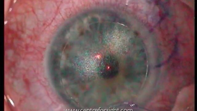 Supracor Clinical Laser Eye Surgery 2.m4v смотреть онлайн