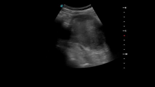 Переходноклеточная карцинома ЧЛС и мочеточника. Transitional cell carcinoma of the pelvis and urete смотреть онлайн