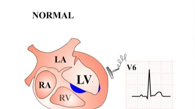 ECG Interpretation - STEMI (Section 3, Part 2) смотреть онлайн