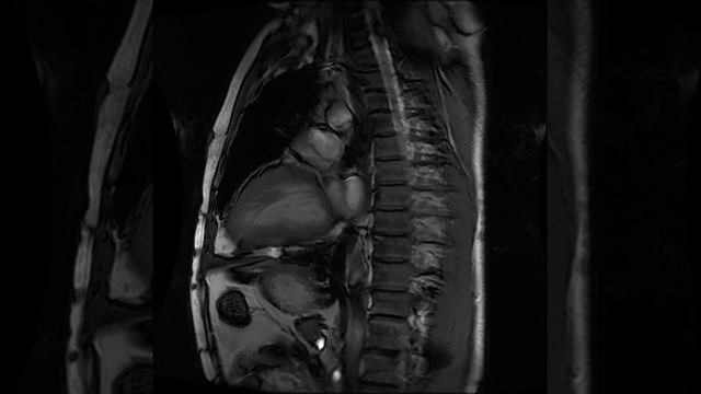 CARDIAC MRI (2 Chamber FIESTA CINE 8 2) смотреть онлайн