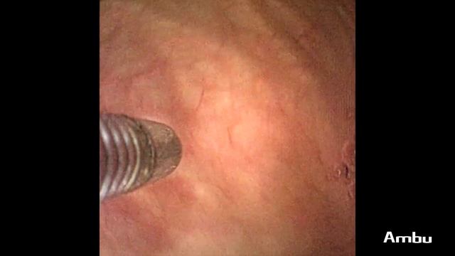 Overactive Bladder Injection | Dr. Michael Kennelly With The Ambu® AScope™ 4 Cysto