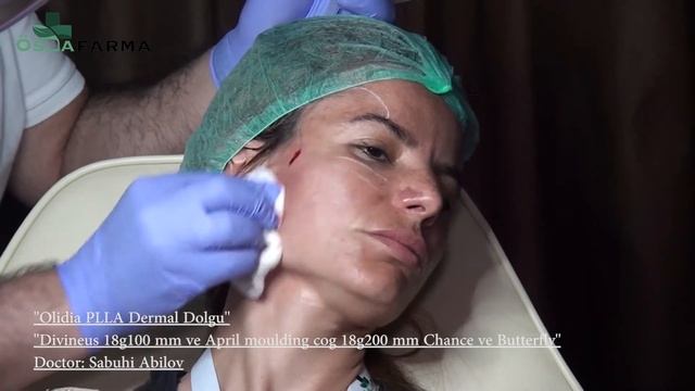 Olidia PLLA Dermal Dolgu Uygulaması