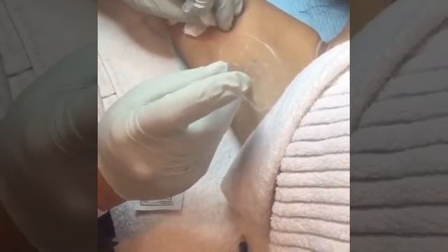 Botox to treat Hyperhydrosis смотреть онлайн
