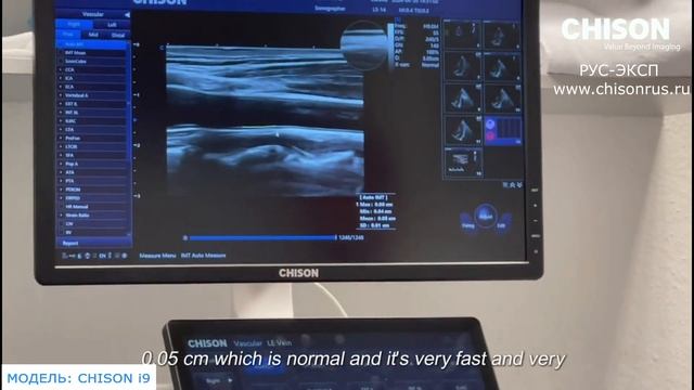 CHISON i9 обзор УЗИ аппарата экспертного класса смотреть онлайн