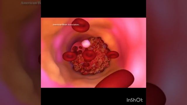 Thrombosis in Urdu/hindi смотреть онлайн