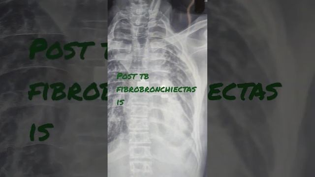 #post-TBFibrobronchiectasis post TB fibrobronchiectasis смотреть онлайн