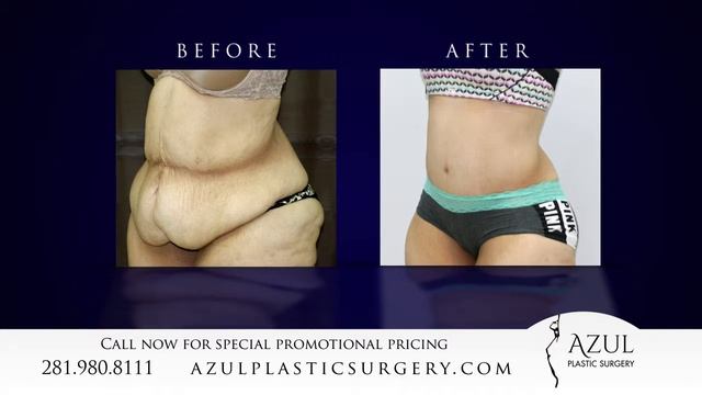 Houston Tummy Tuck after Weight Loss at Azul Plastic Surgery Sugar Land Woodlands TX смотреть онлайн
