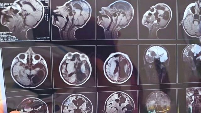 "МИКРОЦЕФАЛИЯ" Как определить  истинную  или приобретённую форму. смотреть онлайн