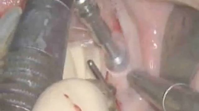 Сверление пилотного отверствия с использованием сверла 210L16 как часть имплантологического лечения смотреть онлайн