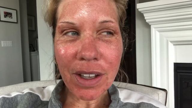 Day 3 C02 fractional skin laser anti aging over 50 Pore reducer смотреть онлайн