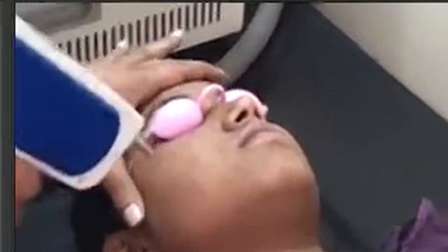 1064 Yag laser on Freckles by Dr Bhutada (India) смотреть онлайн