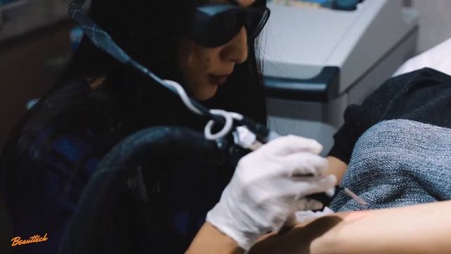 Cynosure lazer epilasiyası смотреть онлайн