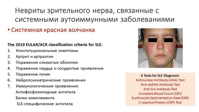 Редкие формы оптического неврита смотреть онлайн